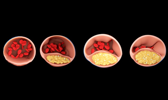 triglicéridos diabetes alcohol azúcar