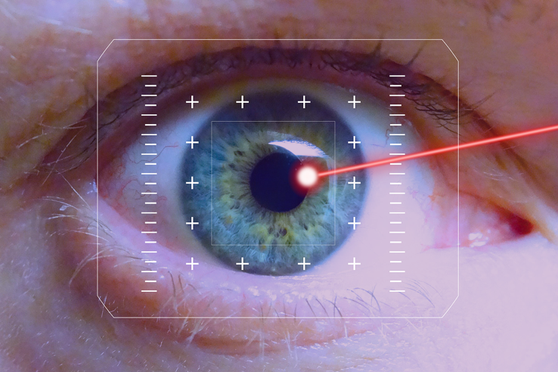 Picture showing laser surgery on the eye to treat Glaucoma