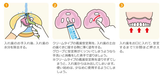 八戸市　歯医者　くぼた歯科　入れ歯　ノンクラスプ　オススメ　安定剤