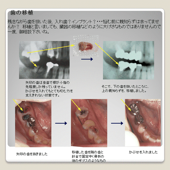 すぎやま歯科移植症例