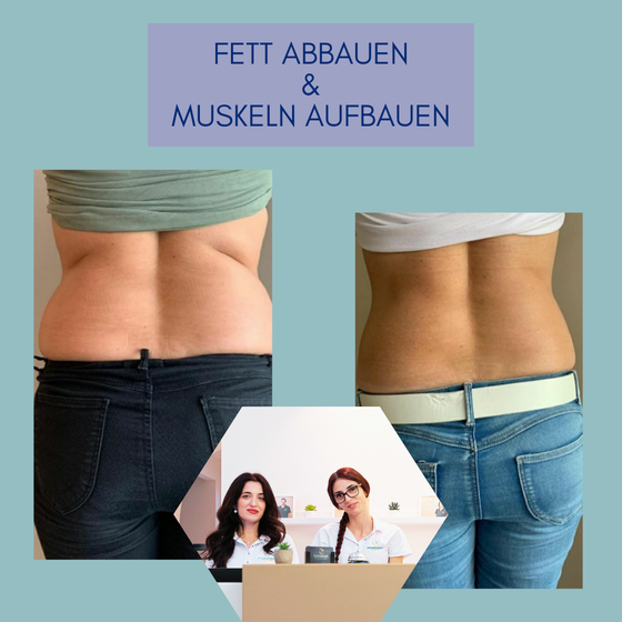 Body straffung emshape