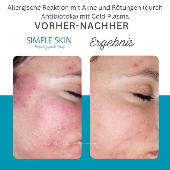 Vorher Nachher Akne Allergische Reaktion mit Cold Plasma