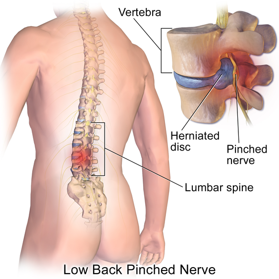 *飛び出た椎間板=Herniated disc、圧迫された神経=Pinched nerve