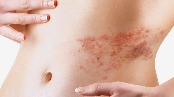 Gurtelrose Homoeopathie Sissach Liestal Basel Olten Bern Zurich Luzern