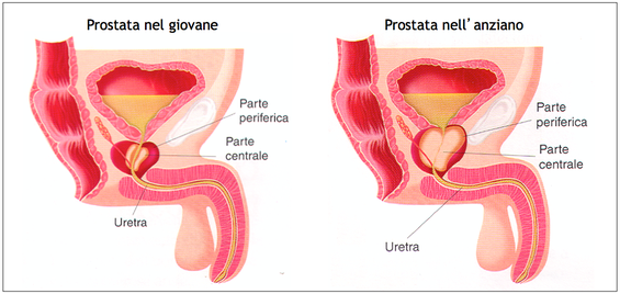 nodulo prostata benigno Milyen gyertyák prosztatitis