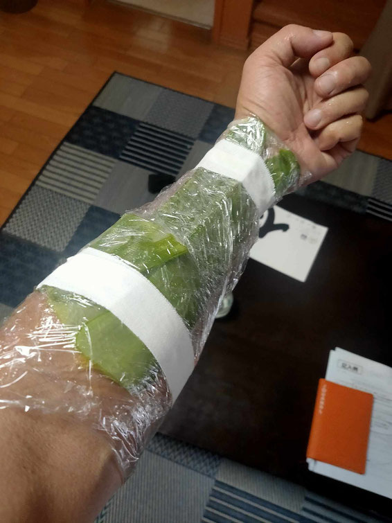 やけど部にアロエを巻いた図