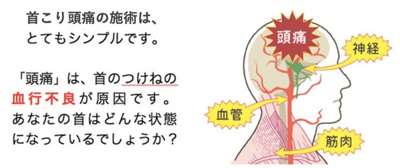 偏頭痛が治った　首の付け根から頭痛　頭痛