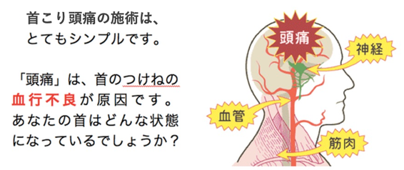 偏頭痛が治った　首の付け根から頭痛　頭痛