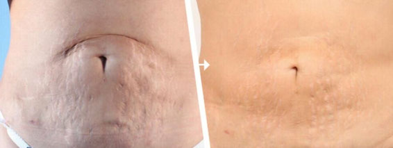 RF Micro nadeln in Basel