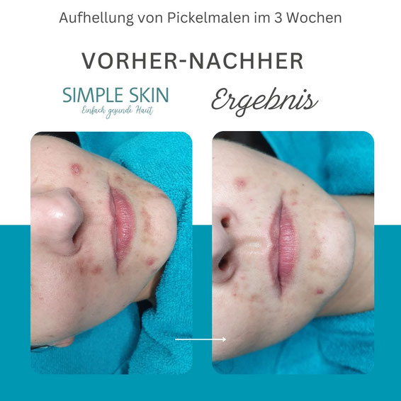Pickelmale Aufhellung Kratzakne Skin Picking