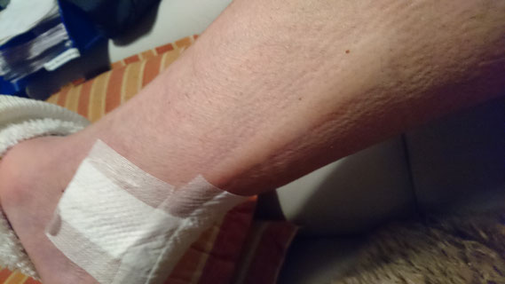 Druckstelle vom Aircast - dachte zuerst die Sehne ist verrutscht -hihihi-