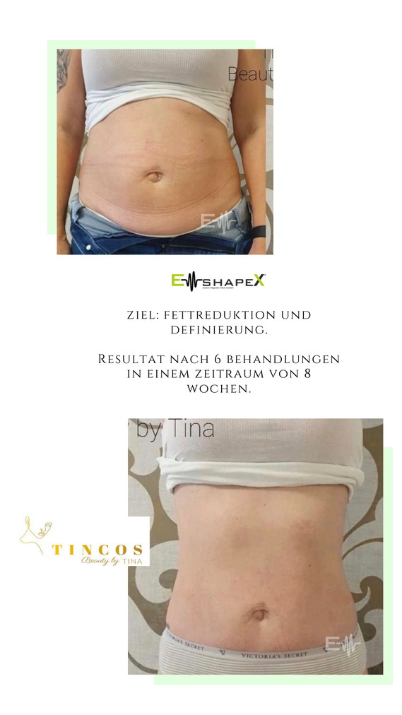 Vorher und Nachher Bilder vom Body Sculpting