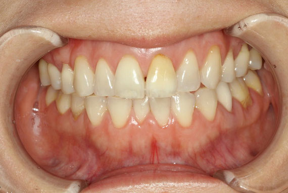 歯茎の再生前