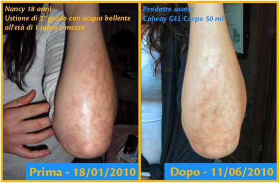 Come Trattare Le Macchie Da Ustione Scottatura E Bruciature Benvenuti Su Benessereok Jimdo Com