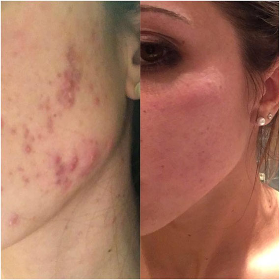 Combattere Acne Brufoli E Foruncoli Benvenuti Su Benessereok Jimdo Com