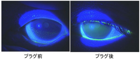 涙点プラグによるドライアイの治療