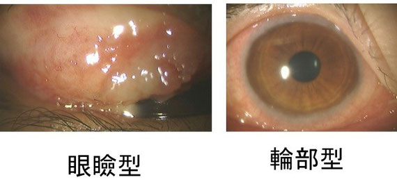 コロナ 結膜炎 片目