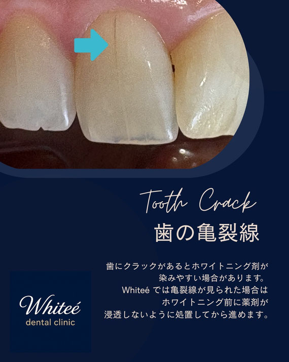 Whiteé dental clinicの症例写真（歯の亀裂線）