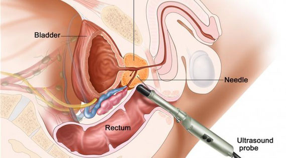 ecografia prostatica transrettale è dolorosa)