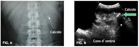 FIG. A Rx addome: calcolo radiopaco. FIG. B Ecografia renale: calcolo con relativo con d'ombra