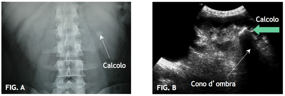 FIG. A Rx addome: calcolo radiopaco.  FIG. B Ecografia renale: calcolo con relativo con d'ombra