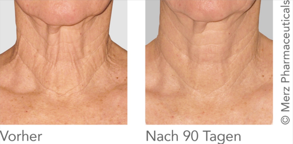 Ultherapy