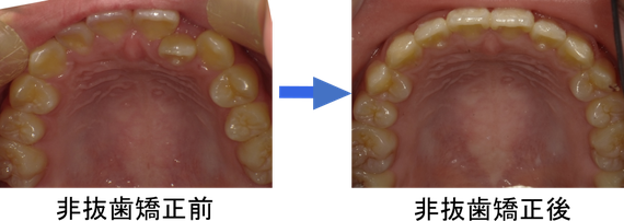 非抜歯矯正