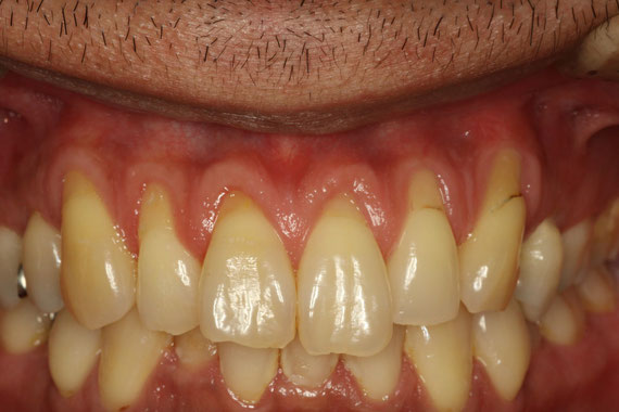 歯茎の退縮