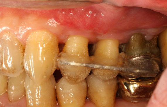 歯ぐきの再生治療後の経過