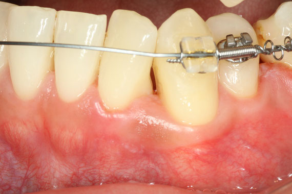 矯正治療後の歯茎の退縮