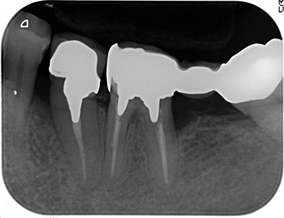 歯と歯の間の骨が無くなってしまったレントゲン像