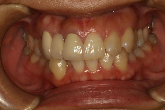 歯茎の再生と審美歯科治療