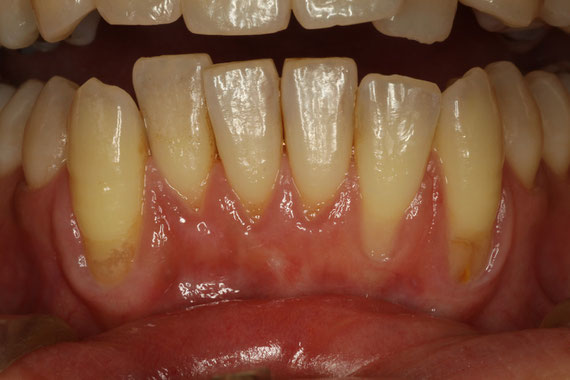 下の前歯の歯茎の退縮