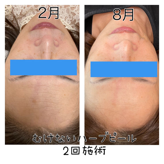 サーマクールFLX - クィーンメイク21