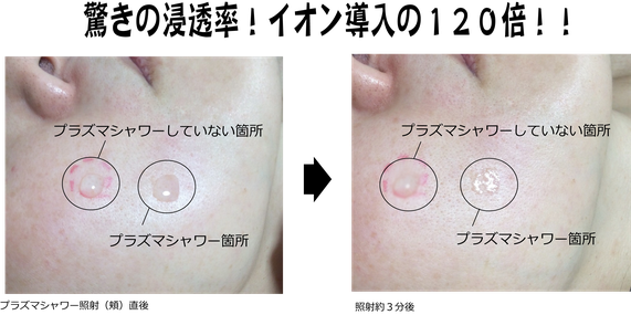 札幌　豊平　口コミ一番　肝斑　プラズマシャワー　激安アンチエイジング　毛穴　透明感　くすみ　目元　しわ　クリニック