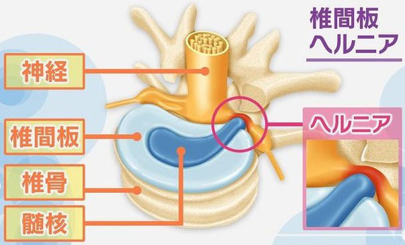 腰椎ヘルニアの分類図