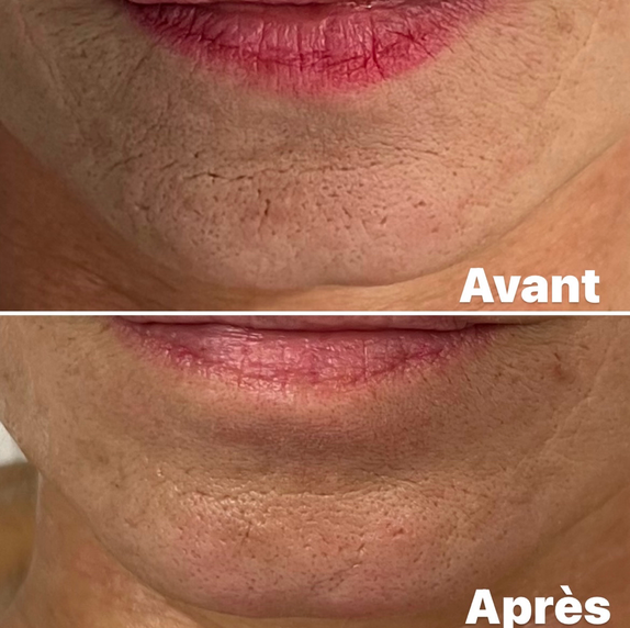 Avant/Après 1 séance microneedlind menton: pore resserrés, peau plus lisse et lumineuse, rides estompées. Effet glow