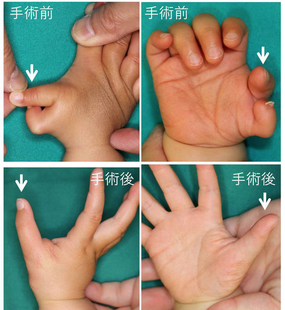 母指多指症　レベルⅥ　手術前と手術後