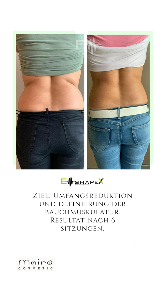 wann darf man EMS Sculpting nicht machen?