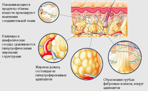 Целлюлит Майорка