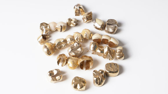 Sammlung von Zahngold, Goldkronen und Brücken zur Wertermittlung vor dem Ankauf.