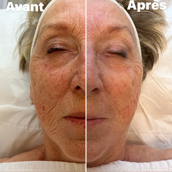 Avant/Après 1 séance microneedlind visage complet: tient unifié et taches pigmentaires atténuées; pore resserrés, peau plus lisse et lumineuse, rides estompées. Effet glow