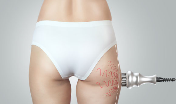 Cellulite Behandlungen Basel 