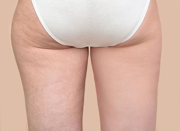 Anti Cellulite Beratung Basel