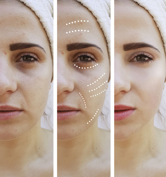 Peeling Kosmetik Basel, Fruchtsäure Treatment