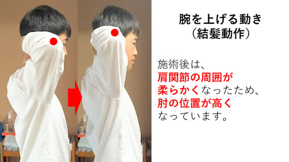 右投げ中学生キャッチャーの野球肩施術前後の腕を上げる動きの比較