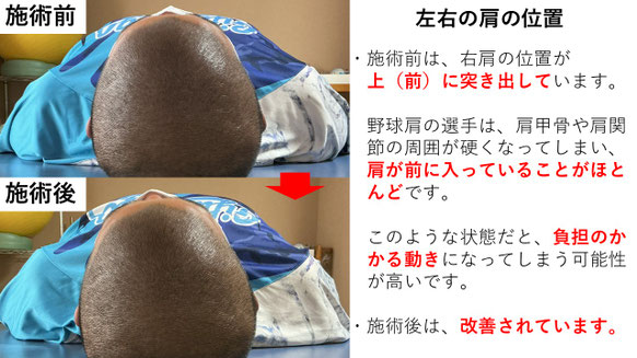 右投げ高校生ピッチャーの野球肩施術前後左右の肩の位置の比較