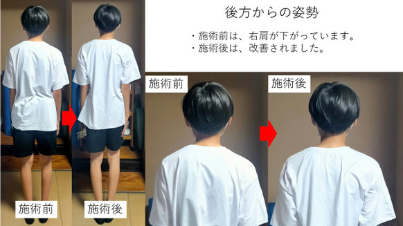 右投げ中学生ピッチャーの野球肩後方からの姿勢施術前後比較　