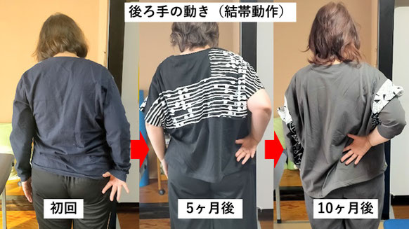 五十肩の施術例。初回から10か月後にかけて肩の可動域が改善し、後ろに回せるようになった症例