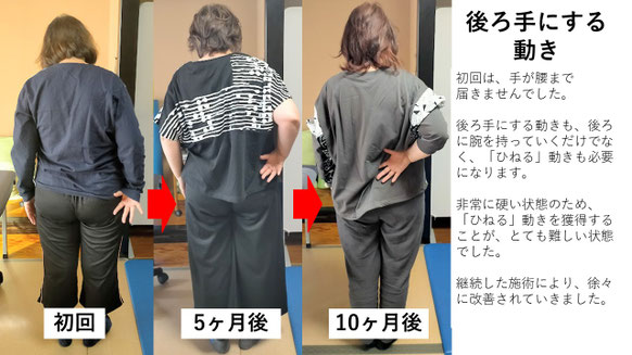 五十肩の施術例。初回から10か月後にかけて肩の可動域が改善し、後ろに回せるようになった症例